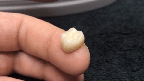 Що значить сон про що випавші зубні коронки — 30 тлумачень