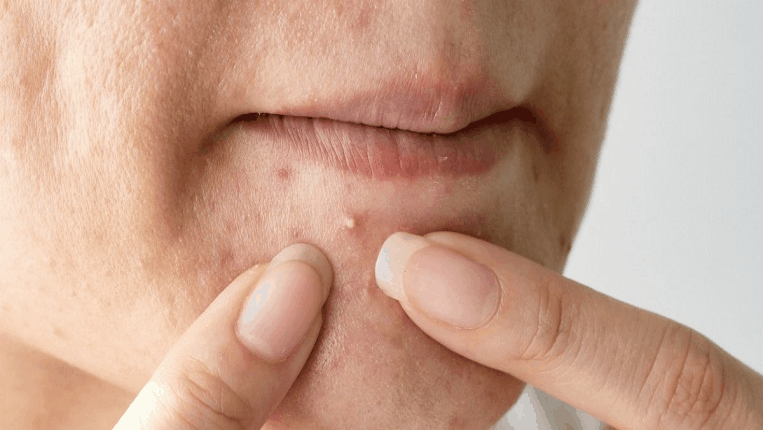 42 значення сну про видавлювання прищів на обличчі